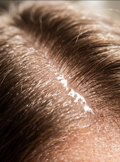 Serum Growturn con Exosomas para el Cuero Cabelludo – Tratamiento Anti Caída y Crecimiento